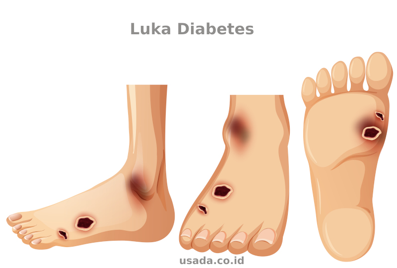 Fakta-Fakta Mengenai Perbedaan Diabetes Basah dan Kering